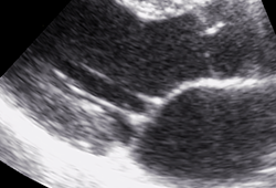 Parasternaler Längsschnitt